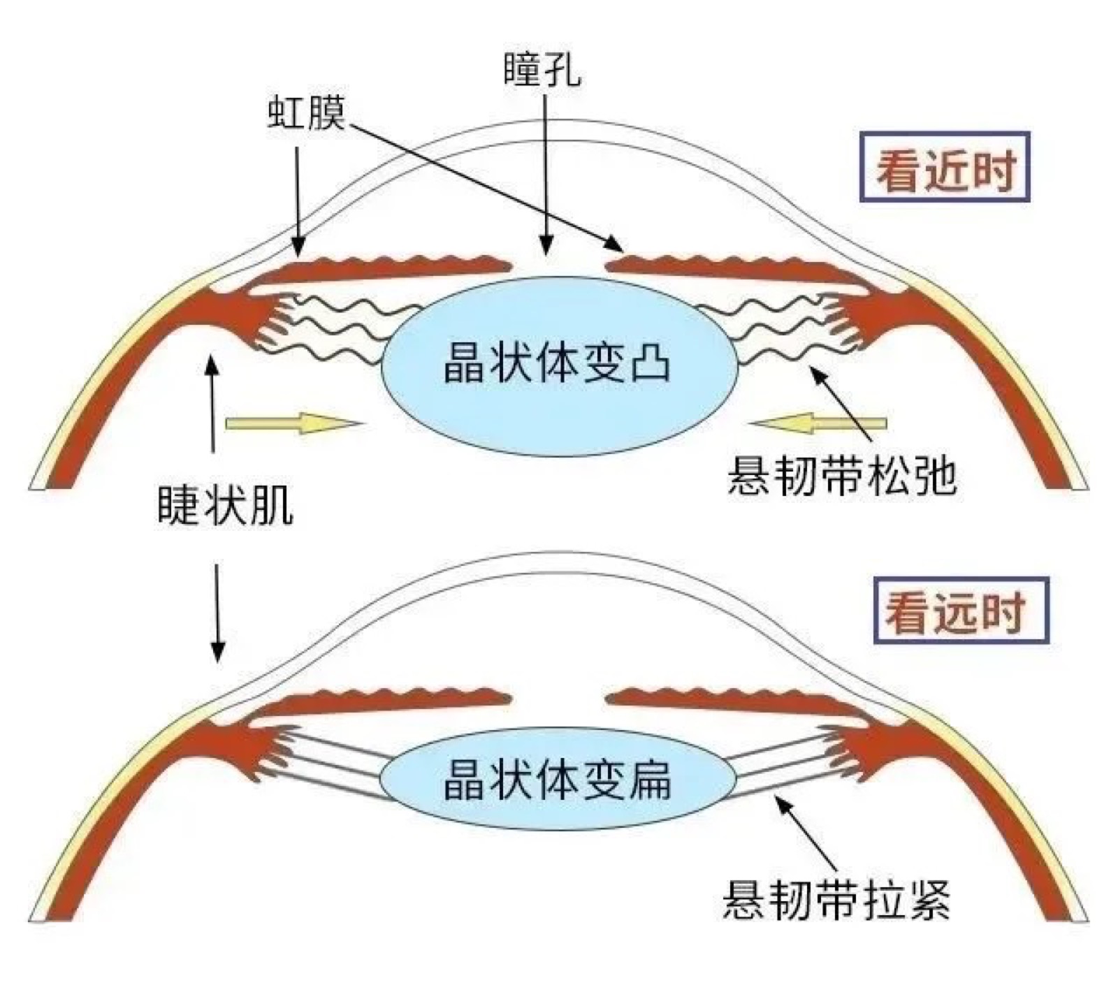 做完近视手术又看不清了？先别慌，可能是这几个原因配图