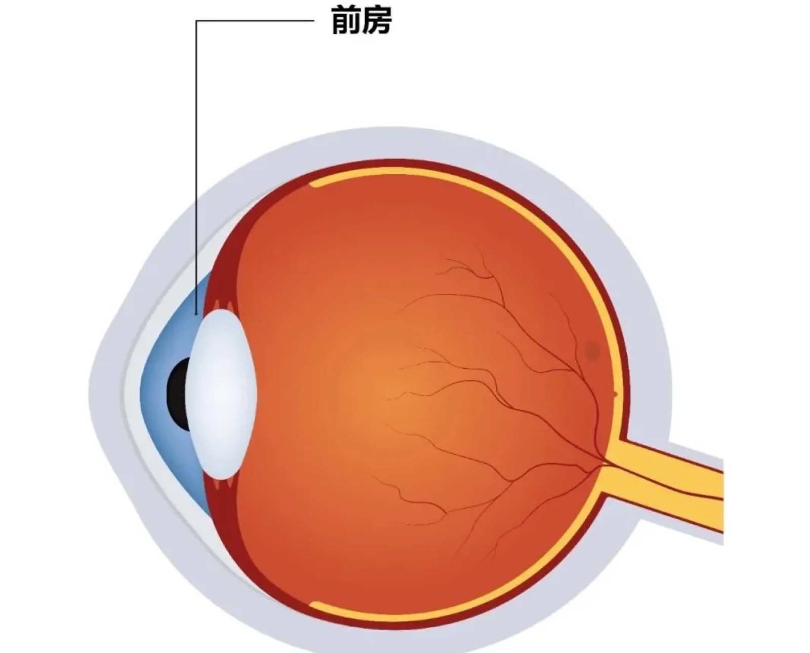 好纠结……想做近视手术，选激光，还是ICL？配图