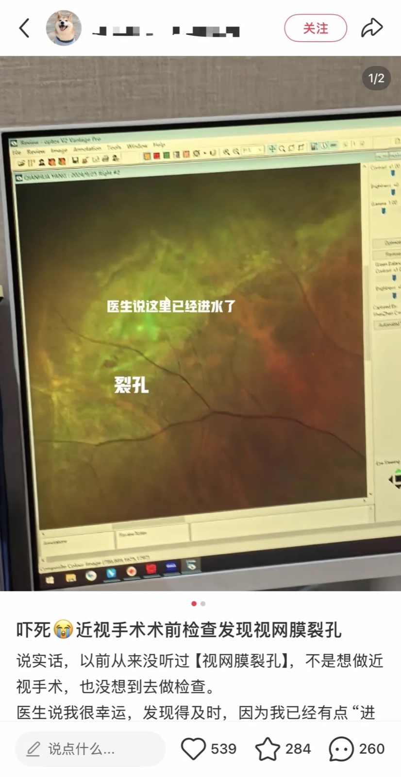 好纠结……想做近视手术，选激光，还是ICL？配图