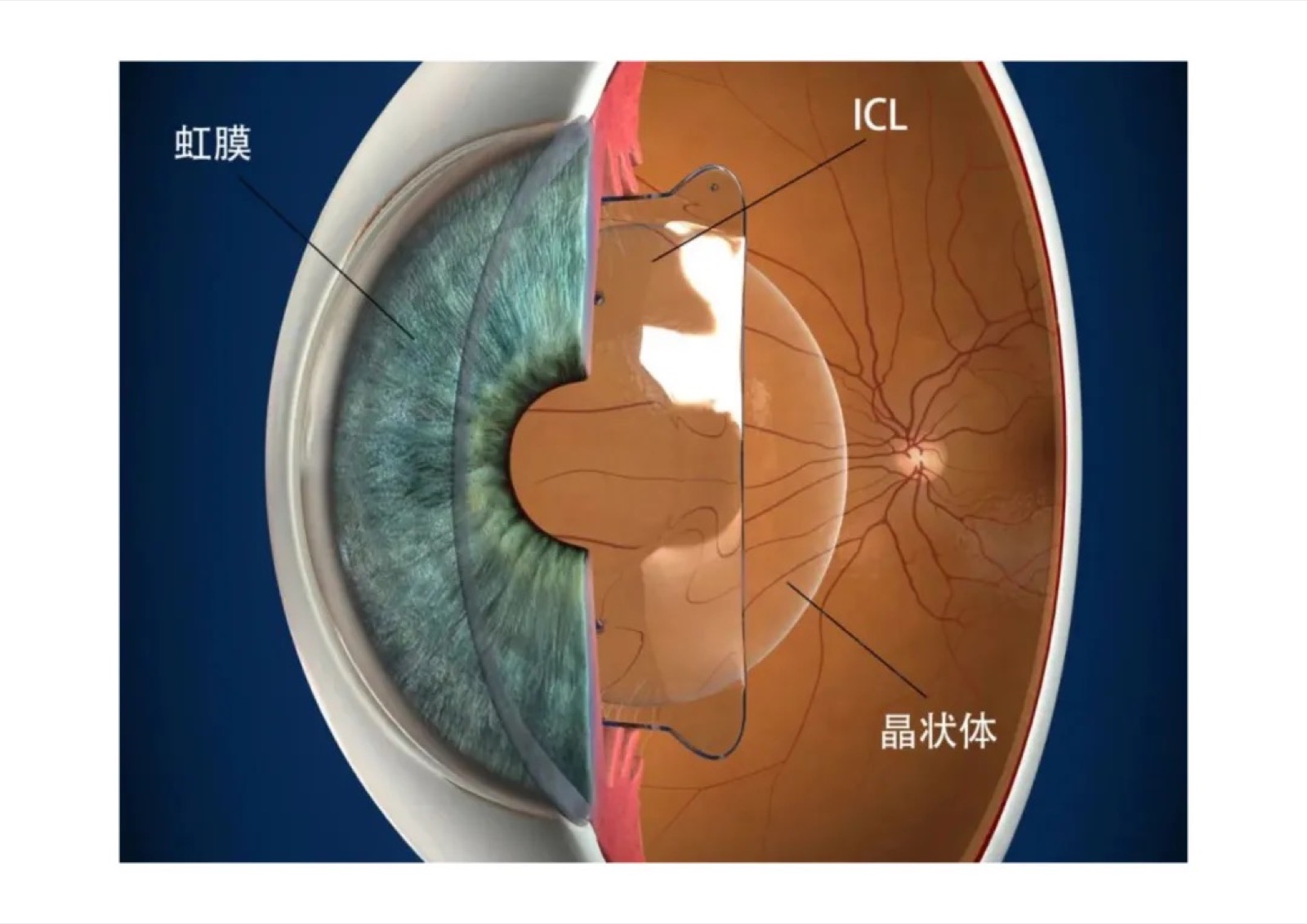 往眼睛里放东西，想想都怕？ICL的25个真相，看完再抖！配图