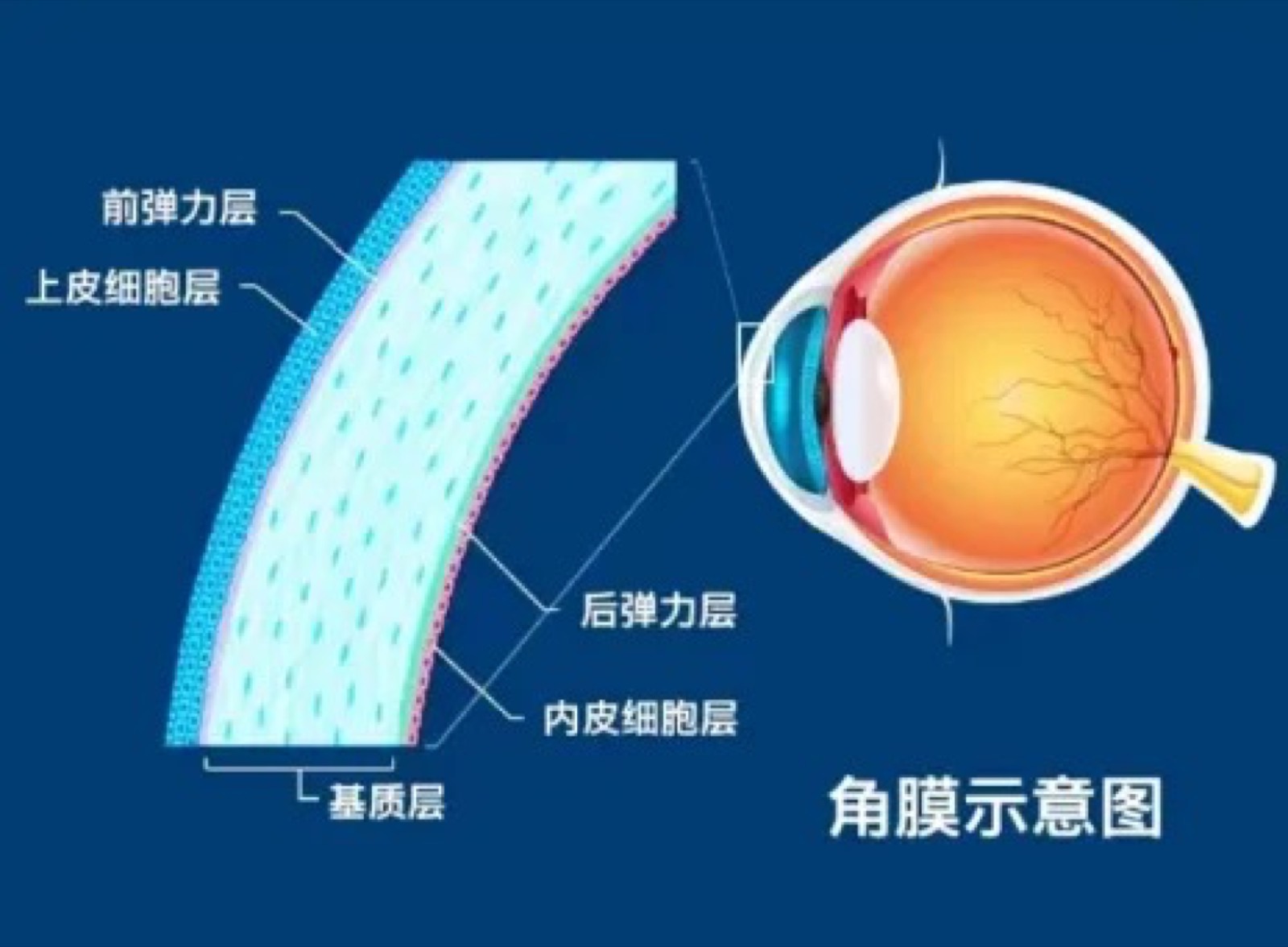 拜托！都2026年了，这些近视手术谣言还在传？配图